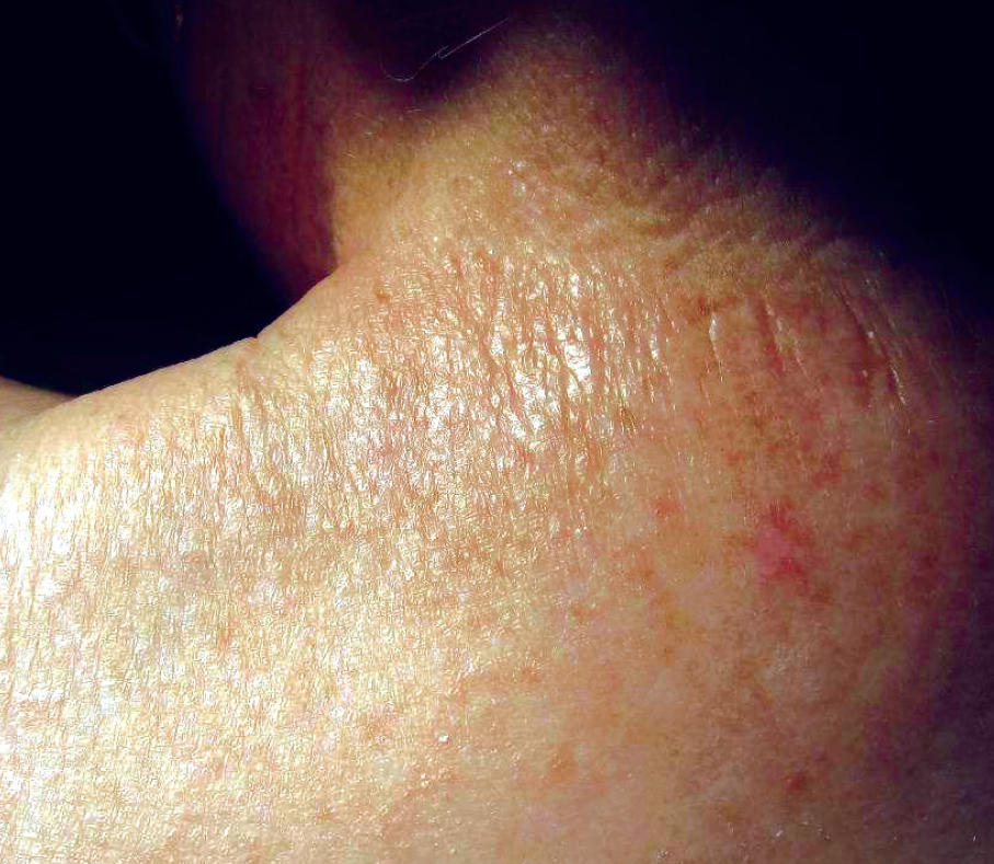 lichen sclerosus male cure Laplante